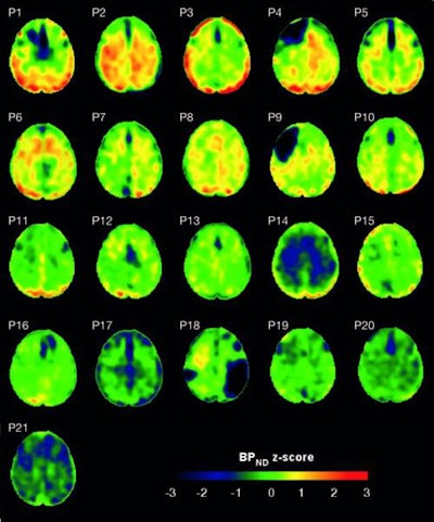Flortaucipir nondisplaceable binding potential (BPND) z-score maps for each TBI patient are compared by voxel to healthy controls. TBI subjects are presented in descending order by number of voxels with flortaucipir BPND (z > 1.645). Patchy cortical and subcortical increase in tracer uptake is observed in some TBI participants, most consistently in the lateral occipital cortex (P1 to P8 and P10), while other TBI maps show similar BPND values as healthy control subjects (P17 to P21). Images courtesy of Gorgoraptis et al and Science Transitional Medicine.