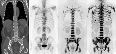 Multi-modality imaging of the skeleton shows secondary deposits in bone. Diffusion-weighted MRI (far right image) is a quantitative technique from which a biomarker called the apparent diffusion coefficient can be derived either from specifically segmented regions or from the whole skeleton. Image courtesy of Prof. Nandita deSouza.