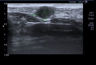 Cancer ratio was less than 1.5 in this case of a 33-year-old woman who presented with a lump in the left breast. Intermittent left nipple inversion was present for years. On examination, a tiny nodule was found, as marked in the lower inner quadrant (LIQ) of left breast (P2). Breast ultrasound showed a 10 x 6-mm lesion in the LIQ that looked suspicious. Grade 2 breast cancer with length/width ratio of 1.46 was the diagnosis. Although in some respects this looks like a fibroadenoma, the cancer ratio suggests that biopsy should be (and was) undertaken. Each nodule should be considered on its merits and should be assessed on a number of criteria -- of which the length versus width ratio should be one. Image courtesy of Dr. Christopher Loughran.
