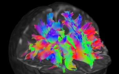Scan of a newborn baby's brain visualizes information diffusion-weighted MRI data acquired as part of the Developing Human Connectome Project and shows the direction of different nerve fibers. Image courtesy of the Developing Human Connectome Project.
