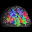 2019 09 25 17 36 6712 D Hcp Dwi Mri Kids Brain Scans 400