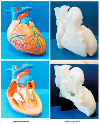 Generic heart model (left). Individually tailored 3D-printed model of a patient with congenital heart disease (right). Image courtesy of Lau et al. Licensed under CC BY-NC 4.0.