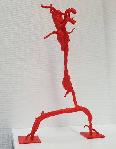 A 3D-printed vasculature model of a patient with an abdominal aneurysm who underwent endovascular aneurysm repair for a closed right iliac artery.