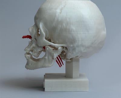A 3D-printed head model of a man who had a fork (red) lodged in his nose. The surgical team examined the 3D-printed model to plan the fork removal. All images courtesy of Dr. Lars Brouwers.