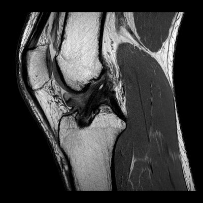 A 28-year-old female professional football player with a past history of ACL rupture of the right knee presents with anterior knee pain and locking. Top: Sagittal MR image shows wad of arthrofibrosis in the intercondylar notch. Bottom: Axial MR image shows ovoid focus of scar tissue in anterior aspect of notch. All images courtesy of Dr. David Connell.