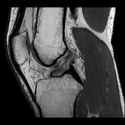 Same 28-year-old female football player with acute pivot shift injury. Top: Sagittal MR image shows failure of the native ACL injury. Bottom: Corresponding fat-suppressed sagittal image shows contusion beneath the posterior lip of the lateral tibial plateau.