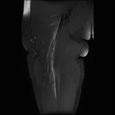 A 25-year-old professional football player presents with an acute injury to the right hamstring. Top: Coronal fat-suppressed image shows rupture of the intramuscular tendon rachis of the biceps femoris muscle in the proximal third of the thigh. Note detensioning of the intramuscular tendon, resulting in a wavy appearance. Bottom: Corresponding axial scan shows absence of the intramuscular tendon as consequence of tendon failure and retraction.