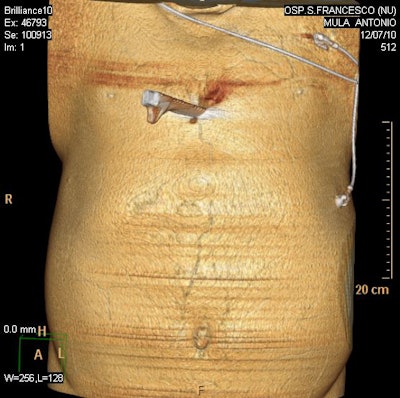 Above: Shaded surface display CT reconstruction highlights the entry point of the blade on the thoracic surface. Below and bottom: Volume-rendered 3D reconstructions demonstrate the relationships between the blade and the sternum. All images courtesy of Prof. Giuseppe Guglielmi, University of Foggia and the Scientific Institute Hospital in San Giovanni Rotondo, Italy.