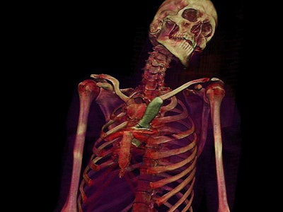 Images of a murder victim who was stabbed in the chest with a kitchen knife. All images courtesy of Prof. Anders Persson, PhD, director of the Center for Medical Image Science and Visualization (CMIV) in Linköping, Sweden.