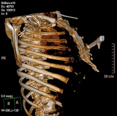 3D reconstruction of knife wound