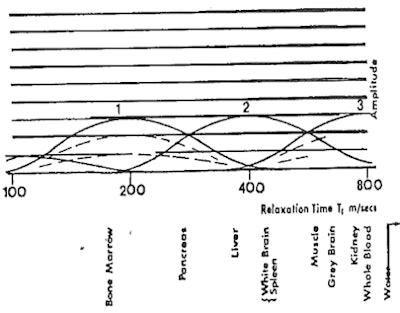 Above: Godfrey Hounsfield's diagram relating signal amplitude to the log of tissue T1 including gray brain and white brain. Hounsfield presented this during his Nobel lecture on 8 December, 1979. The curve opposite the numeral 2 shows white matter with higher amplitude than gray matter as seen on the IR image (TR/TE = 1000/300 ms) of Ian Young's brain. Below: Young's brain obtained at the EMI Central Research Laboratory in autumn 1979.