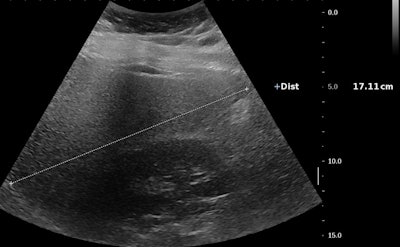 Ultrasound of a 14-year-old girl with severe obesity (body mass index [BMI], 42 kg/m2). There is hepatomegaly associated with increased liver echogenicity when compared to the right kidney and attenuation corresponding to severe steatosis. Below, the same patient shows increased liver-to-kidney ratio. All images courtesy of Dr. Stéphanie Franchi-Abella, PhD.