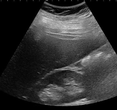Ultrasound of a 16-year-old girl with severe obesity (BMI, 51 kg/m2) but no increase in liver echogenicity. She was considered not to have liver steatosis.