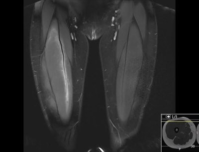 Coronal and axial images of a 17-year-old soccer player who has had two weeks with pain, especially when kicking the ball. The images show edema in the rectus femoris muscle, concentrated around the intramuscular deep tendon. Soccer injury is common, and muscle injuries in the leg and thigh may be seen in typical locations. The rectus femoris has a peculiar architecture, and edema and muscle strain may have a strange presentation if the radiologist is not familiar with the anatomy. All images courtesy of Dr. Roar Pedersen.