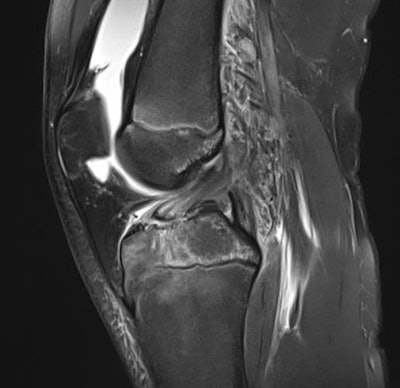 A young population will present with different injuries than adults. Physeal stress and changes are common, as are bony avulsions. Above, a 14-year-old soccer player sustained a knee trauma one week ago. Sagittal proton-density fat-suppressed (PDFS) image shows an avulsion of the distal insertion of the anterior cruciate ligament (ACL), with some diastasis. If not imaged in the acute phase, or if there is less diastasis, such an injury may be overlooked.