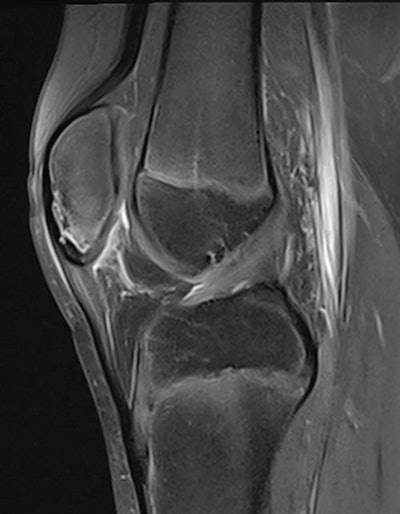 A 10-year-old athlete had anterior knee pain after a period of intense physical activity. Sagittal image shows stress reaction in the inferior part of the patella and changes suspicious of patellar sleeve avulsion.