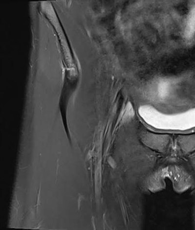 A 23-year-old soccer player had hip pain after a forceful kick. Injury to the proximal origin is shown on a coronal image of the rectus femoris, with a partly avulsed fragment from the spina iliaca anterior inferior. The tendon is intact and conservative treatment will heal the injury.