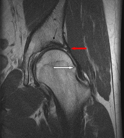 Coronal proton density-weighted MR image shows femoroacetabular impingement of the cam type. 'Bump' from bone formation at the femoral head/neck junction (white arrow) with full-thickness articular cartilage defects of acetabulum (black arrow) and labral tear (red arrow). All images courtesy of Dr. Patricia Cunningham.