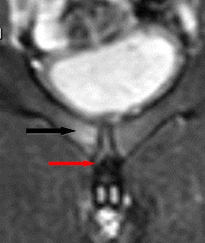 Coronal short-tau inversion-recovery (STIR) MR image shows a right accessory cleft sign (red arrow) with parasymphyseal marrow edema (black arrow) compatible with adductor/gracilis dysfunction and osteitis pubis.