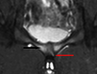 Coronal STIR MR image shows a left accessory cleft sign (red arrow) with parasymphyseal marrow edema (black arrow) compatible with adductor/gracilis dysfunction and osteitis pubis.