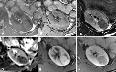 Typical appearance of a fat-poor angiomyolipoma: isointense or very slightly hyperintense in T1 (A), with or without a signal drop on opposed-phase image (B), hypointense in T2 (C), with clear diffusion restriction on the apparent diffusion coefficient (ADC) map (D), hyperarterialized and with a rapid washout (F). Image courtesy of Dr. Nicolas Grenier, and Société française de radiologie (SFR) -- reproduced with permission from the SFR's e-Quotidien des JFR.
