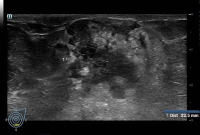 Above: A BI-RADS 5 mass visualized on ultrasound. Below: The same mass, vascularized in doppler.