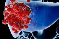 2019 10 30 17 20 3763 Liver Cancer 400