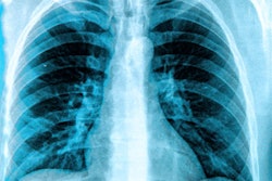 2017 12 01 19 18 0879 X Ray Chest Lungs 400