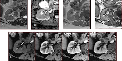 Aspect typique d'un carcinome à cellules claires montrant, comparé au parenchyme rénal normal, une intensité de signal élevée en T2 (A), un coefficient de diffusion apparent élevé (ADC) (B), une chute de signal sur l'image en opposition de phase (D), par rapport à l'image en phase (C) et une vascularisation élevée sur l'image dynamique rehaussée (E). Image reproduite avec l'aimable autorisation de Pr Nicolas Grenier.