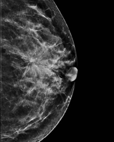 Image synthétique reconstruite à partir des coupes de tomosynthèse. Toutes les images sont reproduites avec l'aimable autorisation de Dr Luc Ceugnart.