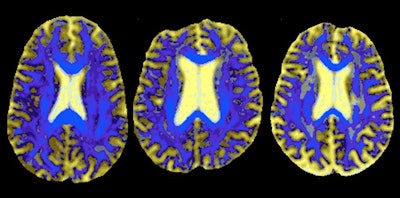 Axial diffusion-tensor image segmentation images of the reference brain (left), a stable small-vessel disease patient who did not progress to dementia (middle), and a patient who developed dementia during the study (right). Image courtesy of Williams et al, Stroke, October 2019, Vol. 50:10, pp. 2775-2782. CC license.