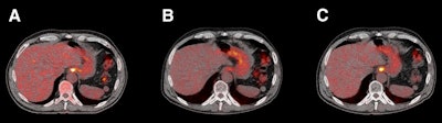 FDG-PET/CT at baseline (A), 12 weeks (B), and 24 weeks (C) after completion of neoadjuvant chemoradiotherapy. Initial clinically complete response at 12 weeks was followed by an increase in FDG avidity at 24 weeks. In view of these findings, esophagectomy was performed, and residual tumor was found in resection specimen. Resection was radical, and tumor margins were free of disease. Images courtesy of JNM.