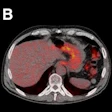 2019 11 06 22 27 7331 Esophageal Images Jnm Valkema 400