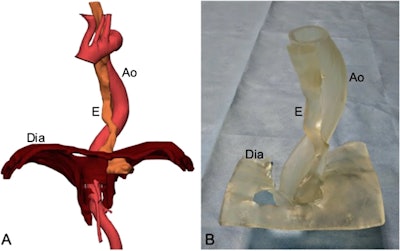 Left: Virtual 3D model of the distal esophagus (E), diaphragm (Dia), and aorta (Ao) based on CT scans. Right: 3D-printed model of the distal esophagus and its relationship with the mediastinal structures. Image courtesy of Marano et al. Licensed under CC BY-NC 4.0.