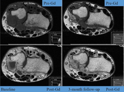 MR images of the wrist at baseline and three-month follow-up, pre- and postgadolinium (Gd), show reduction of synovitis and tenosynovitis. Images are from Diakonhjemmet Hospital and not an actual patient in ARCTIC. Images courtesy of Dr. Espen Haavardsholm.