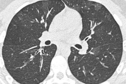 2019 11 11 18 25 0489 Vaping Ct Inflammation 400
