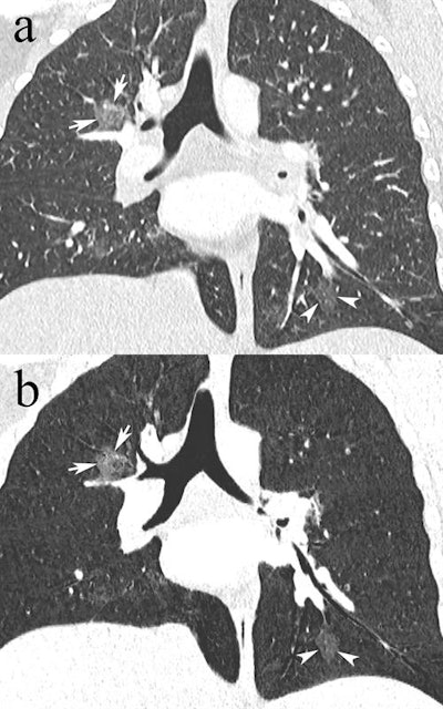 Coronal reformatted CTPA in a 23-year-old pregnant woman presenting with dyspnea and desaturation. Images in lung window (a) showed multifocal pulmonary ground-glass opacities in the right upper lobe (white arrows) and left lower lobe (white arrowheads), better depicted on minimum-intensity projection (b), consistent with viral pneumonia. The nasal swab was positive for influenza type A. Image courtesy of Drs. David Rotzinger and Sabine Schmidt.