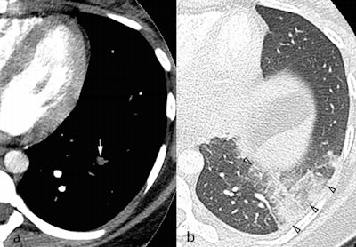 Axial CTPA images in the soft tissue (a) and lung windows (b) from a 25-year-old pregnant woman presenting with acute chest pain. A segmental pulmonary embolus was detected in the left lower lobe (a, white arrow), with associated triangular-shaped areas of subpleural alveolar density (b, arrowheads), consistent with pulmonary infarction. Image courtesy of Dr. David Rotzinger and European Radiology.