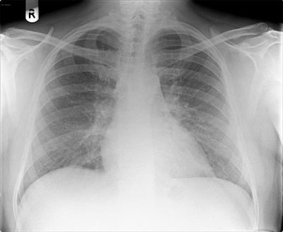 Chest radiograph reported as normal. Note the diffuse ground-glass shadowing in all zones. Images courtesy of Dr. Patrick Liu-Shiu-Cheong, Dr. Owen Dempsey, and BMJ Case Reports 2019.