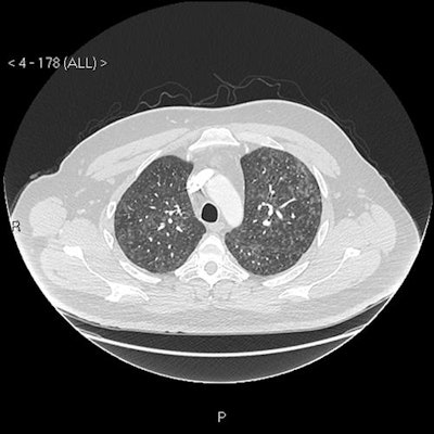 CT scan shows mosaic pattern; apical axial view.
