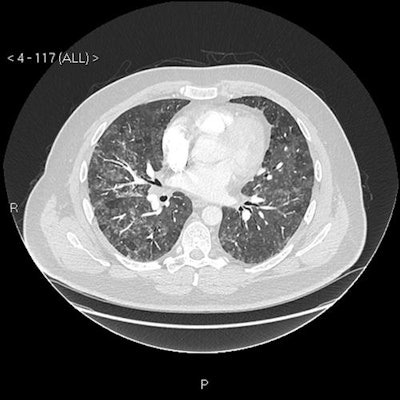 CT scan shows mosaic pattern; middle zones axial view.