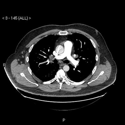 CT scan (mediastinal axial slice) with prominent reactive borderline enlarged mediastinal and hilar nodes.