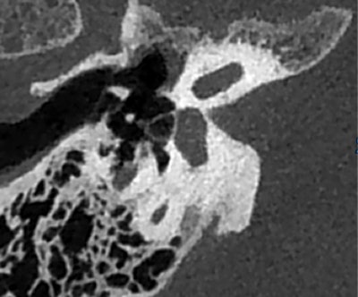 Le CBCT de l'oreille surpasse la tomodensitométrie pour analyser de petites structures telles que l'étrier. L'image est reproduite avec l'aimable autorisation du Pr Veillon.