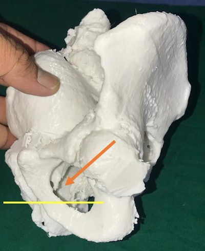3D-printed model of the pelvis based on patient CT scans. A lateral view shows the posterior urethra (arrow) above the inferior margin of the pubic bone, indicating a need for surgical repair. All images courtesy of Dr. Pankaj Joshi.
