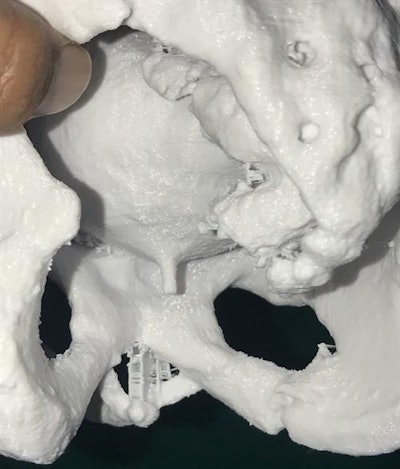 A posterior view of the 3D-printed model showing the posterior urethra in relation to the inferior margin of the pubic bone.