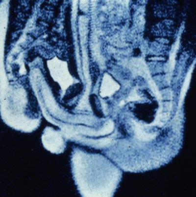 Midsagittal image of the anatomy of sexual intercourse. P = penis, Ur = urethra, Pe = perineum, U = uterus, S = symphysis, B = bladder, I = intestine, L5 = lumbar 5, Sc = scrotum.