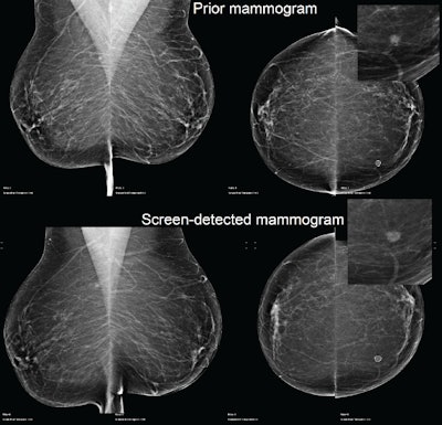 Example of a case of an invasive ductal carcinoma grade 2 screen-detected cancer in the left breast. The AI system recalled both the screen-detected mammogram and the prior mammogram -- read as normal three years earlier -- when operating at the recall rate of the U.K. screening program (4%). Image courtesy of Mark Halling-Brown, PhD.