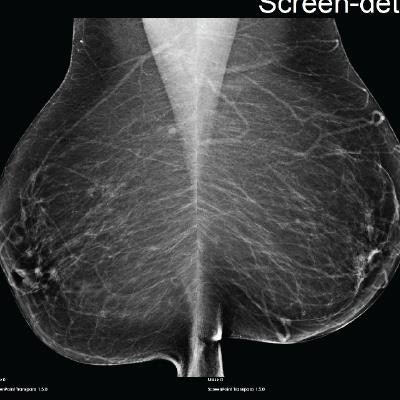 2019 12 01 20 30 3281 Halling Brown Ai Breat Rsna 20191201205911