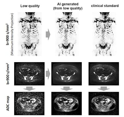 The AI algorithm generates whole-body diffusion-weighted MR images (middle) from subsampled/low-quality (left) but rapidly acquired images. The model generates images of comparable diagnostic quality to the clinical standard (right) and can be used for assessing metastatic disease across the skeleton. Also, apparent diffusion coefficient (ADC) images (a surrogate of tumor cellularity) can be robustly calculated from the AI-generated images, providing a biomarker of treatment response with an increase in ADC values reflecting cell kill. Images courtesy of Konstantinos Zormpas-Petridis.