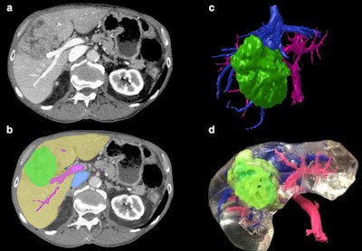 The creation of a 3D-printed liver begins with axial CT scan acquisition (a), followed by image segmentation (b), volume rendering (c), and finally 3D printing (d). Image courtesy of Witowski et al. Licensed under CC BY-NC 4.0.